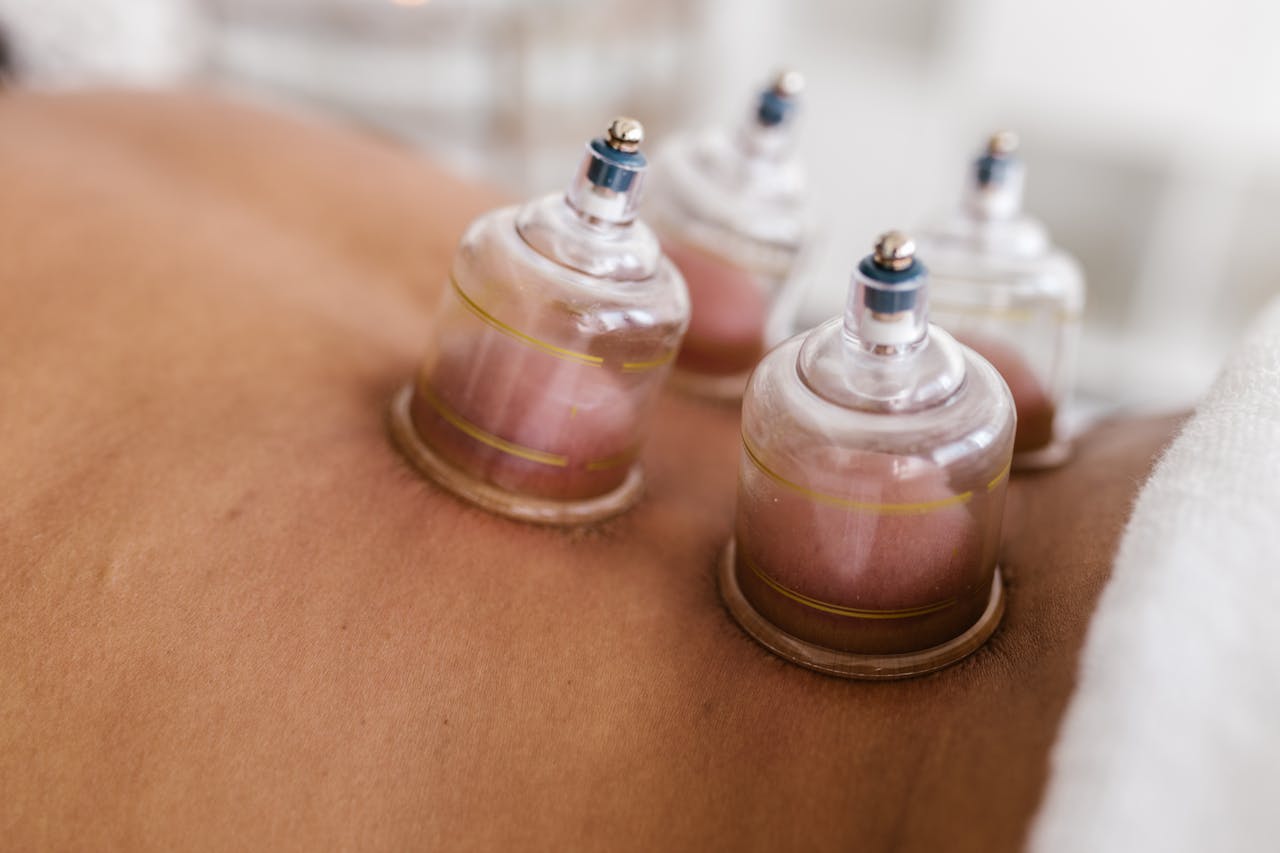 cupping therapy